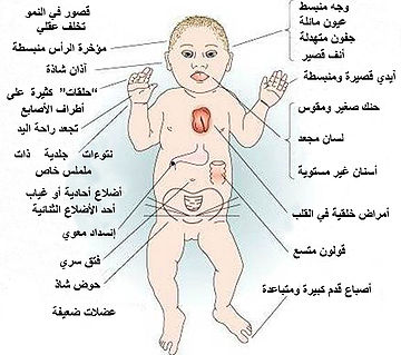 متلازمة داون اسبابها , الدوان عند الاطفال