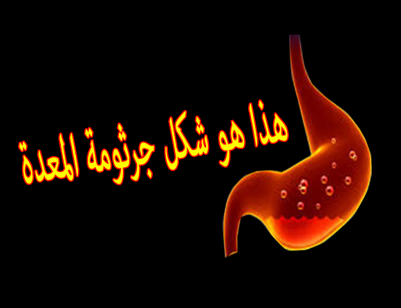 جرثومه المعده والقولون 324146 1