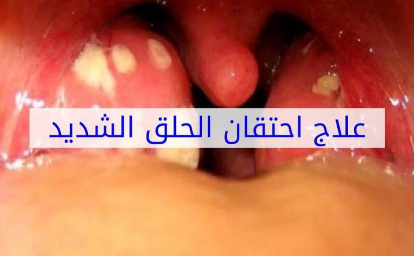 علاج حتقان الصدر عند الاطفال و ودعي البخار نهائي 324138 1