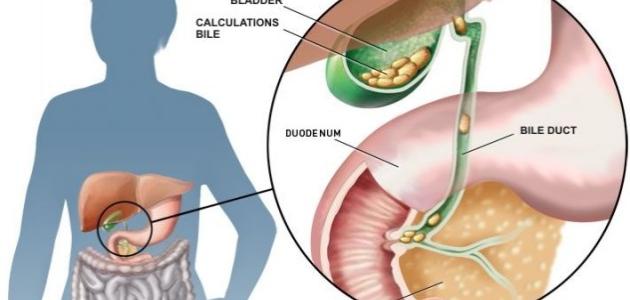 اعراض حصوات المرارة , حصي المرارة وطرق علاجها
