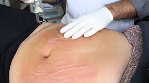 اكبر لعلاجات التشققات stretch marks