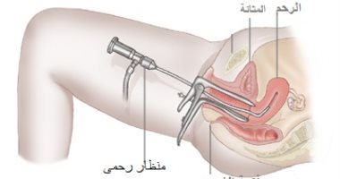 تجربتي مع منظار الرحم - تجارب متنوعه مع منظار الرحم