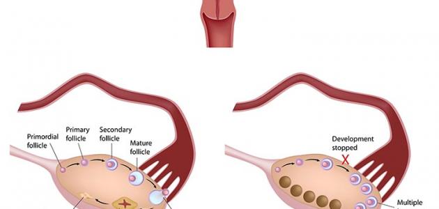 اعراض تكيسات المبايض - علاج تكيس المبايض طبيعيا