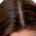 323190 3 علاج تساقط الشعر نهائيا - افضل علاج لقشرة الشعر والحكة اماسي لولان