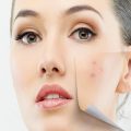 323500 3 وصفة لازالة البقع السوداء من الوجه- طرق علاج بقع الوجه رافي سطام